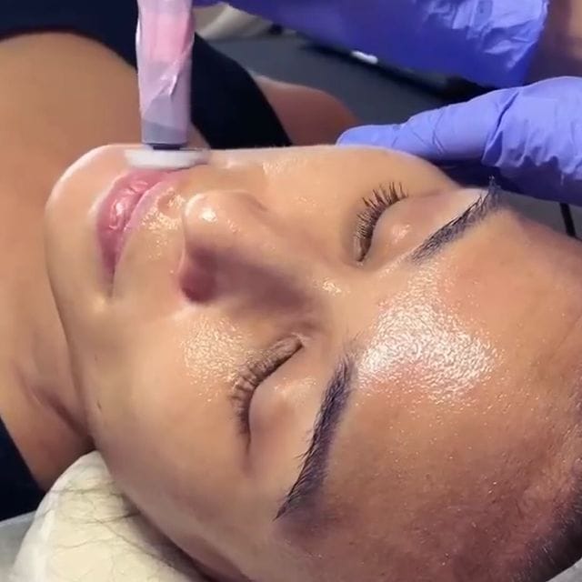 Procell Microchanneling skin treatment at Rejuvia, Stratford Cairns