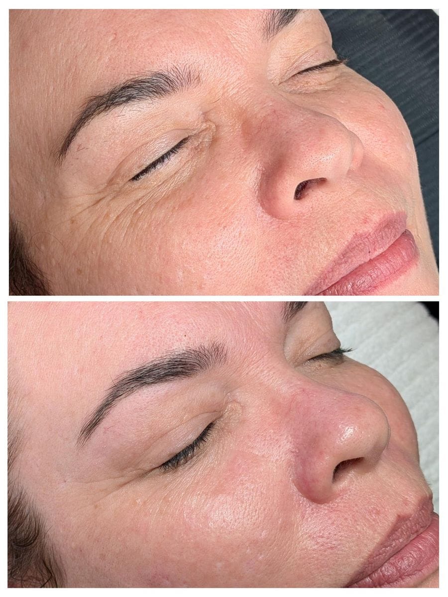 One client's skin before (top) and after (bottom) a course of Procell Microchanneling at Rejuvia, Cairns