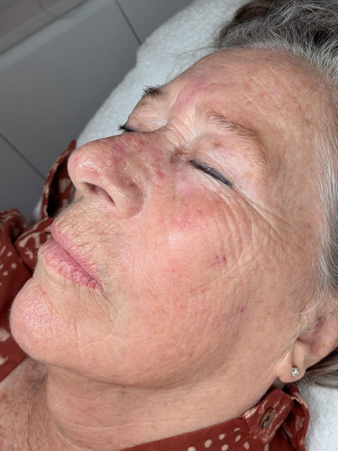 Same client after Procell Nano at Rejuvia, Cairns, front view