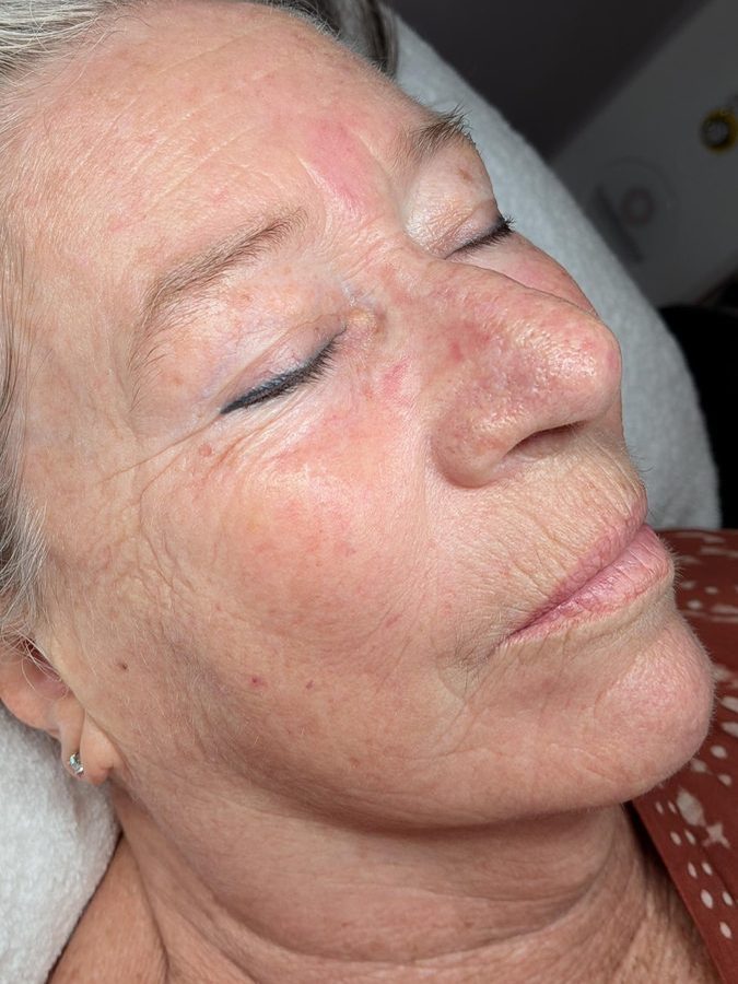 Same client after Procell Nano at Rejuvia, Cairns, side view