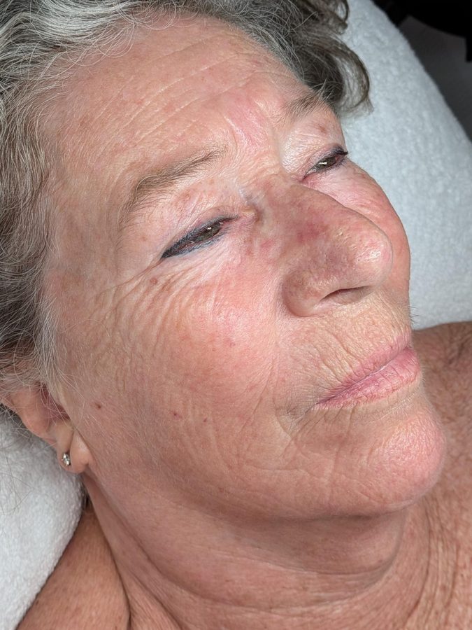 Client&rsquo;s skin before Procell Nano at Rejuvia, Cairns, side view