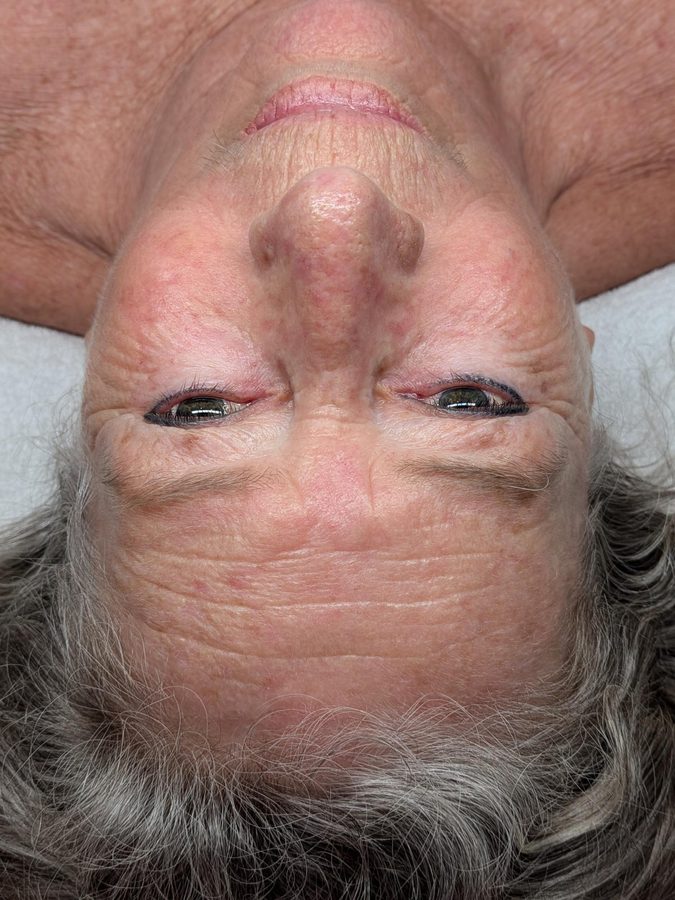 Client&rsquo;s skin before Procell Nano at Rejuvia, Cairns, viewed from above